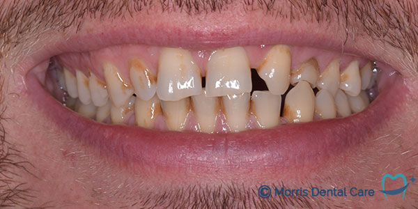Before treatment the patient had worn teeth with some gapping